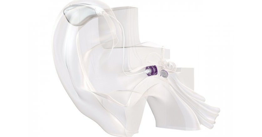 Слуховой аппарат Vibrosonic, расположение в ухе, показанное на 3D модели